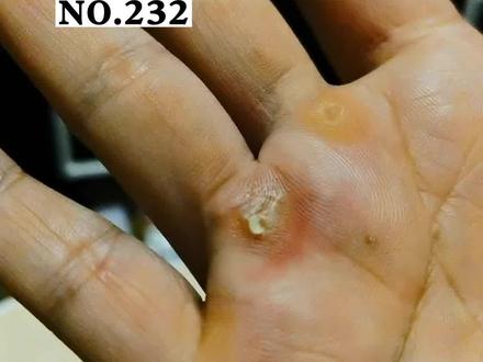 手上长了#老茧 好难看,医生教你一招#茧子 #学生 #医学科普