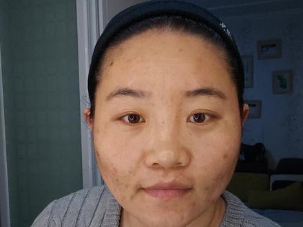 #痘痘肌 #闭口痘痘 不破不立,破而后立,刷酸之后的修复是重中之重,当然还有防晒,哈哈