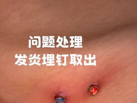 小众审美,谨慎观看 埋钉有寿命且有留疤风险
#直角埋钉 #中山艺耳美专业穿孔打耳洞 #中山手穿 #穿孔师kk #埋钉取出过程