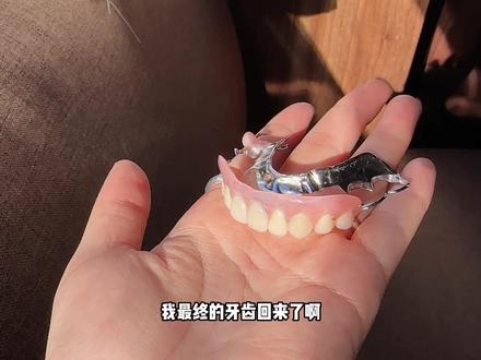 烤瓷牙带了7年|牙齿烂没了|用我的亲身经历告诉你|31岁没牙了#烤瓷牙 #活动义齿支架 #松风塑钢牙 #维他灵支架 #全瓷冠