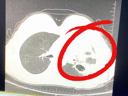 气管镜检查是诊断和治疗气管、支气管和部分肺部疾病的重要方法之一,气管镜检查最大的优势就是可以看见气管里的情况,并准确治疗,精确性高,损伤小。#气管镜#医疗科普
