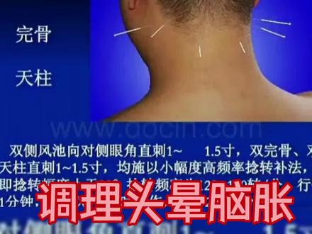 醒脑开窍针法改善椎基底动脉供血不足,调理头晕脑胀 #头晕脑胀 #石学敏醒脑开窍针刺法