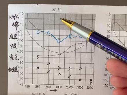 听力报告分析之纯音测听1(下)#如何判断听力好坏