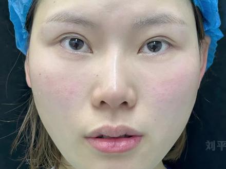 双眼皮分叉深改浅 内眼角回包拆线状态「全集」 #双眼皮修复 #内眼角修复 #双眼皮拆线 #双眼皮深改浅 #刘平眼修复