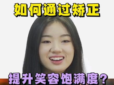 如何通过矫正,提升笑容饱满度? 刚出道时牙齿拥挤不齐
从单依纯的牙齿,我们来看一下牙齿的变化,对人的颜值影响有多大。我们会看到单依纯刚刚出道的时候,她的牙齿有一点点的不齐,特别是她的右上的侧切牙会有点往里面翘,往里面凹进去了。她的从一号牙到二号牙之间就会形成一个明显的台阶。这种台阶呢就会影响整体的观感。
扩弓获得间隙,排齐牙齿
现在单依纯矫正之后的牙齿,微笑线是非常好看的,整个的上牙显得非常的饱满。从我们从前到后做一下对比,会发现她的牙弓也有了一定的扩宽,她可能是通过扩宽牙弓,通过这种扩弓的方式来获得了一部分的间隙,去做一个牙齿的排齐。
通过这样的排齐呢,恢复了整个面下部分的饱满度。会发现她笑起来露齿量稍微还是多了一点。这样呢也和她整个比较阳光的形象,阳光开朗的形象达成了比较一致的统一。
如果拔牙可能瘪嘴
如果是单依纯,这这种牙齿,开始选择了拔牙矫正的话,会出现内收量过大,面下部分看起来饱满度不足的问题。所以说单依纯这种牙齿通过通过扩弓获得空间,完成牙齿的排齐,提高了他她面部的美学状态。