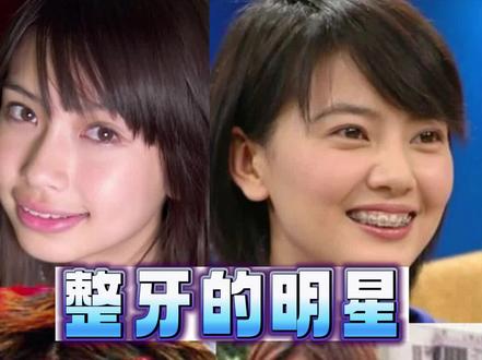 那些整牙后就换头的明星,看完心动了,我也想去矫正牙齿!#angelababy #高圆圆 #小s #蔡依林 #牙齿矫正后的改变