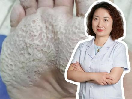 脚底长出马蜂窝 一定要重视!#医学科普 #科普一下 #科普