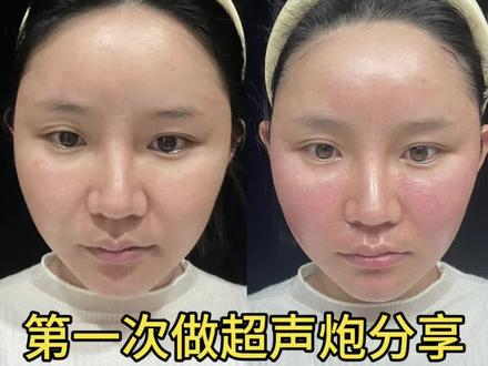 第一次做超声炮分享#超声炮有效果吗 #半岛超声炮