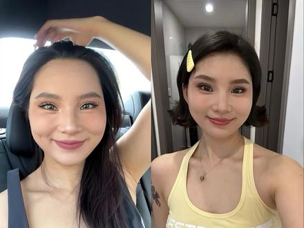 普通人植发5个月真实记录全过程分享来啦!#创作灵感 #植发记录 #变美那些事 #变美逆袭 #拯救发际线