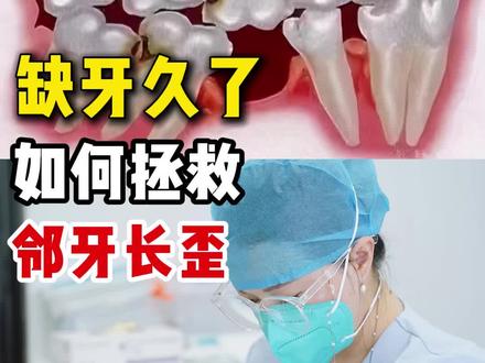 缺牙久了如何拯救临牙长歪#上海虹桥口腔
