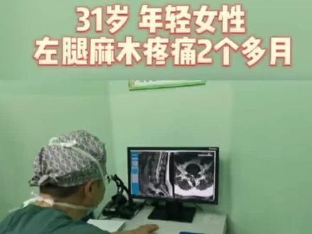 微创脊柱内镜手术解除腰椎间盘突出症患者的困扰。越发觉得微创手术的优势明显,对患者神经干扰小,恢复快。