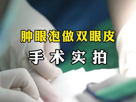 肿眼泡做双眼皮手术实拍 #眼整形医生徐文云 #西安双眼皮徐文云 #西安同城 #双眼皮 #眼综合
