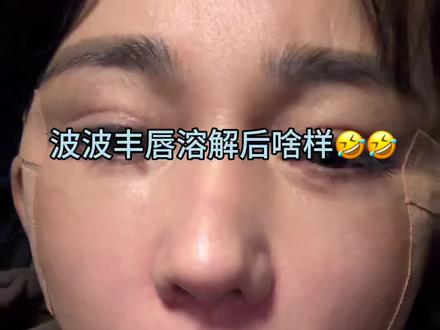 波波丰唇的宝子看过来🤣#嘟嘟唇 #医美微整