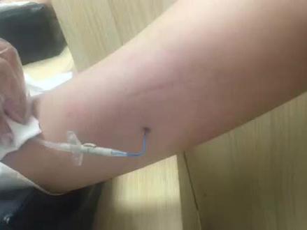 去年9.9感觉天塌了,治疗路上跨过黑暗,迎来曙光抗癌一整年,这根picc置管在女儿体内呆360天终于拔下来了,