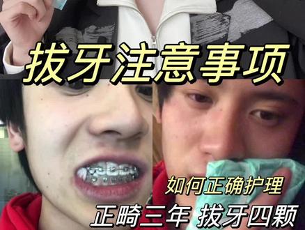正畸拔牙注意事项!牙套人必看 #牙齿矫正 #牙套 #拔牙