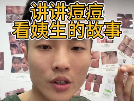 可能这个事情会被骂,在此表示对医生这个神圣的职业无恶意,但是痘痘这个事亲生经历过,并且收集过太多痘友的情况,我觉得,能拉一个是一个吧#痘痘 #拯救痘痘肌 #潮汕巴毛 #异维a酸软胶囊
