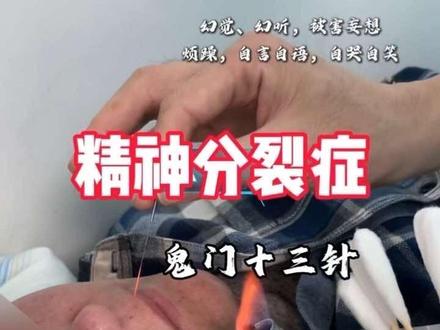 #精神分裂症 #鬼门十三针 #幻听 幻觉幻听、被害妄想、自言自语、自哭自笑、烦躁、便秘、失眠…… #中医 #许辛寅