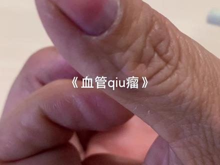 长时间指甲下疼痛 蓝紫色小点 碰触剧烈疼痛 遇冷水诱发疼痛#手指疼痛 #血管球瘤 #手指 #疼痛 #血管