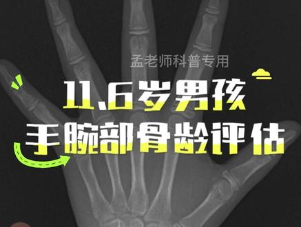 男孩11.6岁,骨龄12岁,预测身高177.3厘米#骨龄检测 #骨龄检测孟老师