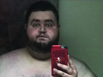 减肥后遗症有多可怕?男人1年狂减270斤肉,皮肤松弛有生命危险!#dou来安利纪录片