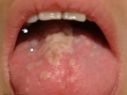 起病急、易高烧,嘴里长满泡,这种病极具传染性#育儿 #健康 @抖音小助手