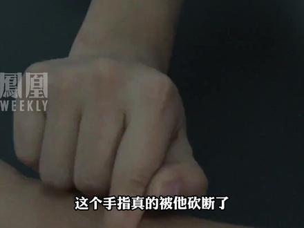 #缅北回流人员自述亡命经历 手指被砍断 不听话被划近80刀,亲眼见到不打麻药被“噶腰子”