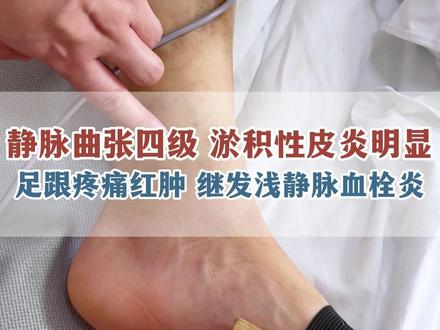 静脉曲张四级 淤积性皮炎明显 足跟疼痛红肿 继发浅静脉血栓炎 #河南省中医院李建鹏主任 #抖出健康知识宝藏 #医学科普