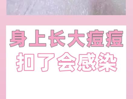 屁股上长了大痘痘,不要扣,扣了会感染哦 #医学科普 #火疖子 #涨知识