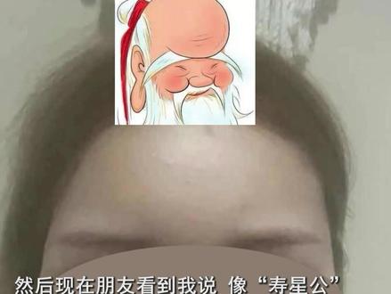#女子做全脸填充额头肿成寿星公 ?整形医院:还在恢复期。