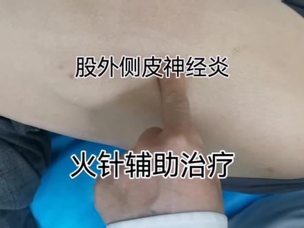 股外侧皮神经炎火针辅助治疗 #神经痛 #神经炎 #股外侧皮神经炎 #股外侧皮神经卡压 #火针 #火针疗法