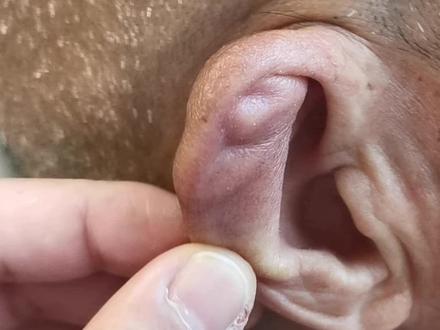 #医学科普 #健康科普
耳廓假性囊肿