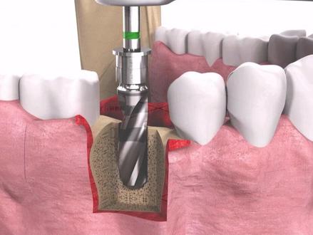 种植牙的全部过程#种植牙 #牙齿 #医学科普 #口腔科普 #一口好牙