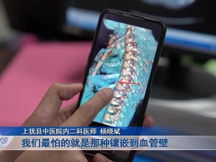 女孩不慎将棒棒糖的塑料棒吞进了喉咙。#重庆dou知道 #新闻