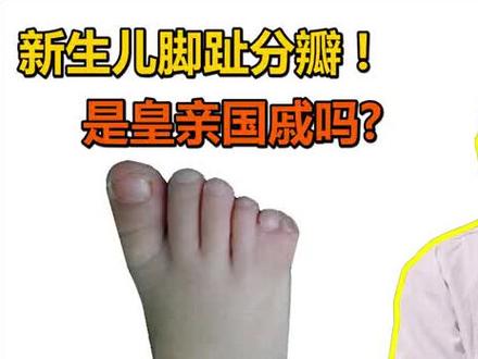 新生儿脚趾分瓣,祖先是皇亲贵族吗?