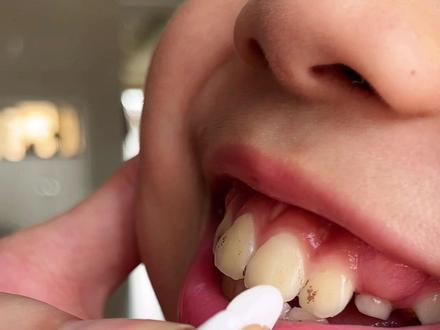 为什么现在小孩的牙齿这么容易发黑?我们小时候的牙齿怎么就从来没有黑过#牙菌斑 #小孩牙齿有黑渍怎么消除 #牙齿美白