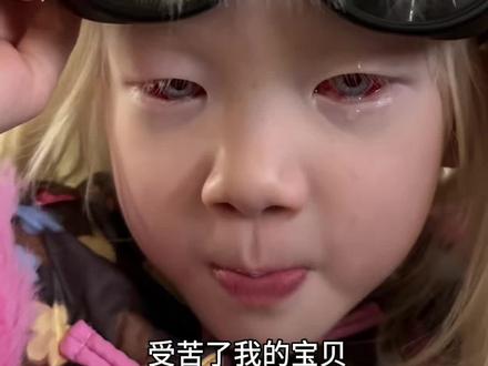 记录女儿做减轻眼球震颤手术的过程,也是纠结了好几年才下定决定给女儿做这个手术,就想着再怎么样也不会比现在差了,不成想术后那么受罪,好在在你睁开双眼后结果还是比较满意的,就希望能稳住不要复发,愿老天能善待你这个坚强的小朋友吧@小爱莎 #眼球震颤手术 #白化病