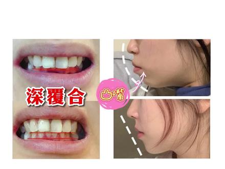 你的牙齿存在深覆合的问题吗?#牙齿 #深覆合 #天包地 #面部问题