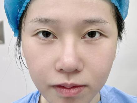 眼尾下垂 眼角显凶回包开扇「全」 #双眼皮修复 #双眼皮手术 #内眼角修复 #开扇双眼皮 #刘平眼修复