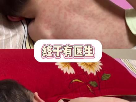 新手爸妈必看!皮肤科主任教你 4 种疹子正确处理 宝宝出疹别乱涂药!4 种疹子区别 + 处理方法,收藏备用!#宝宝疹子 #新手爸妈必看 #湿疹 #荨麻疹 #医学科普