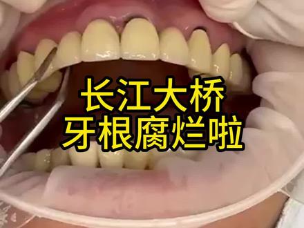 长江大桥桥墩断了,桥也废了!#口腔科普 #假牙 #烤瓷牙