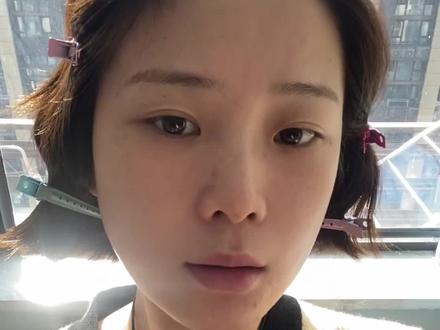 原相机 纯个人观点分享 第三天其实针孔算算好的比较快的 我会用 人体表皮因子去涂加速愈合
#半岛黄金微针#海菲秀#水光#肉毒