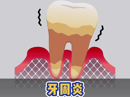 牙周炎牙齿松动怎么办?#发量自救指南