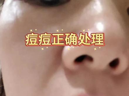 痘痘正确护理#痘痘 #痘印#伤口 #创作者中心 #创作灵感