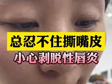 嘴唇上的死皮可别用手撕,可能是#剥脱性唇炎 #医学科普 #护肤 #皮肤问题 #唇炎