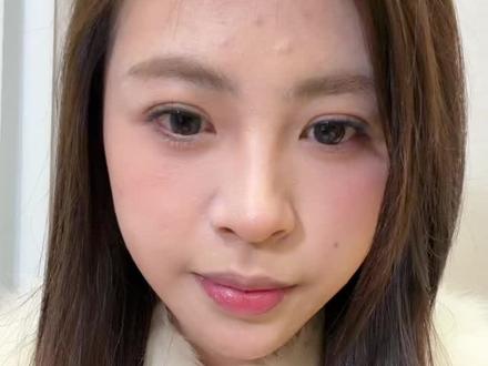 第十天的形态,前段时间没时间发,想了解的可以参考参考#peek下巴 #下巴后缩 #整容需谨慎 #日常分享 #peek