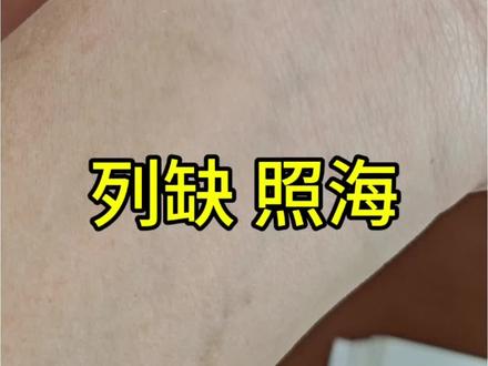 今天再次分享列缺 照海,这次是自己给自己来,没有助手。这次专门讲了没感觉的手法,位置高清无码的全过程,务必认真看完。#针灸调理 #祖传手艺 #生活小妙招
