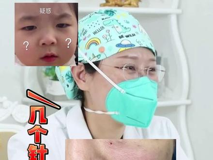 脂肪室复位提升苹果肌和面中部一共会有几个针眼,术后如何保养恢复才能更快#提拉紧致 #面部提升 #苹果肌 #变年轻