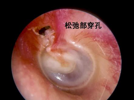 鼓膜穿孔危险不危险? #医学与听力学科普 #人工耳蜗 #健康 #医学科普 #中耳炎 #胆脂瘤