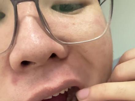 牙疼 牙齿敏感#牙疼#牙齿敏感 #牙釉质再生