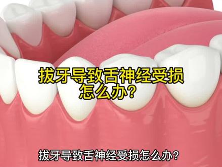 拔牙导致舌神经受损怎么办?#法律咨询 #医疗纠纷 #医生#阻生齿 #舌神经损伤